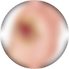 Gangrena piciorului